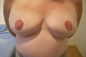  Permanent Areola Repigmentation After