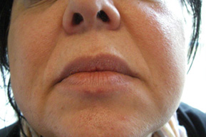   Pernanent Lip Makeup Before